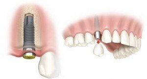 dental implant sherman oaks