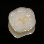 porcelain crowns sherman oaks CA