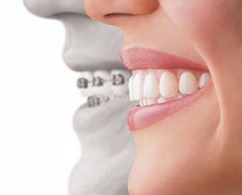 Invisalign Sherman oaks