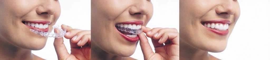 invisalign-sherman-oaks